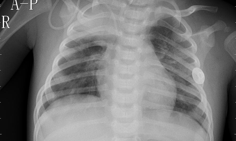 Pneumonia — NIH Chest X-ray14
