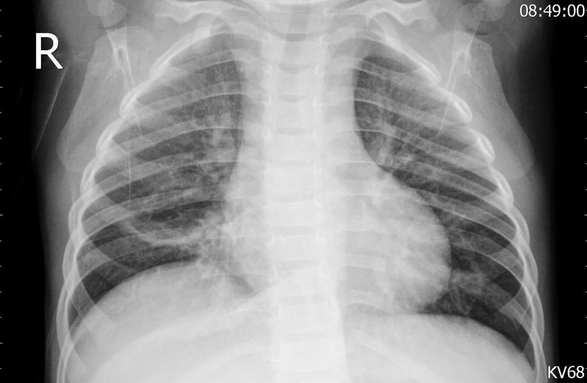 Pneumonia — NIH Chest X-ray14