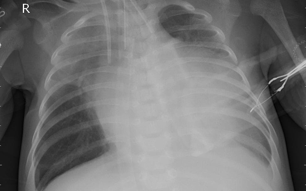 Pneumonia — NIH Chest X-ray14