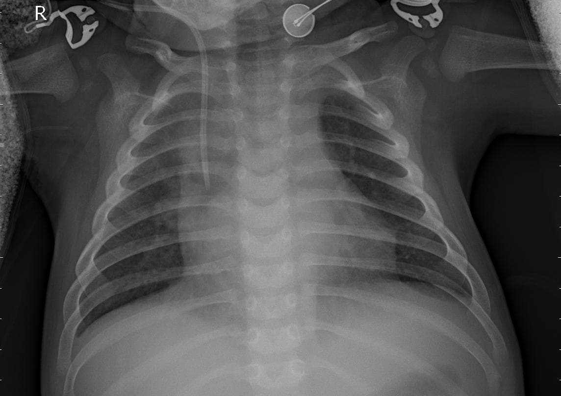Pneumonia — NIH Chest X-ray14