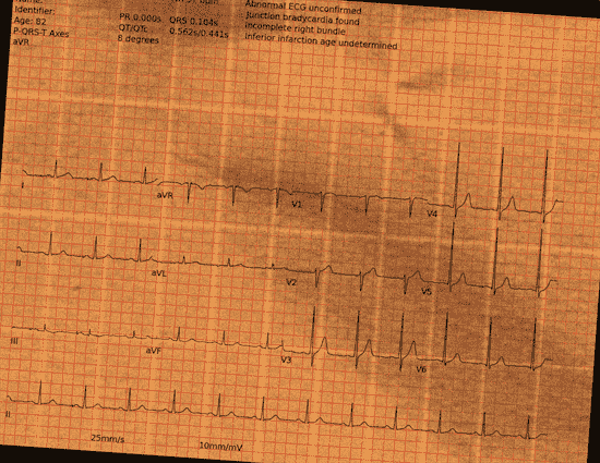 Normal ECG — PTB-XL