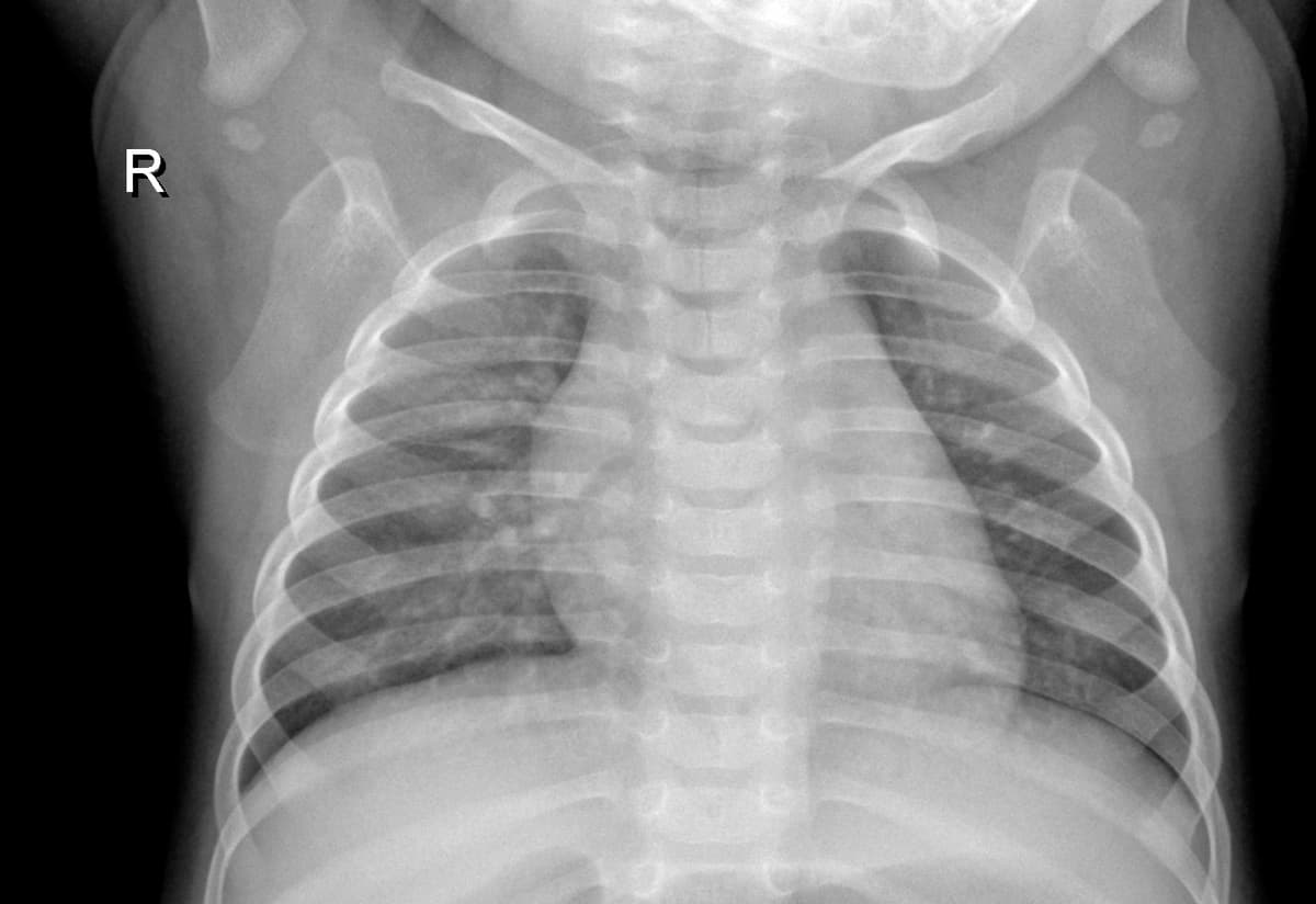 Radiografia Normal — NIH Chest X-ray14