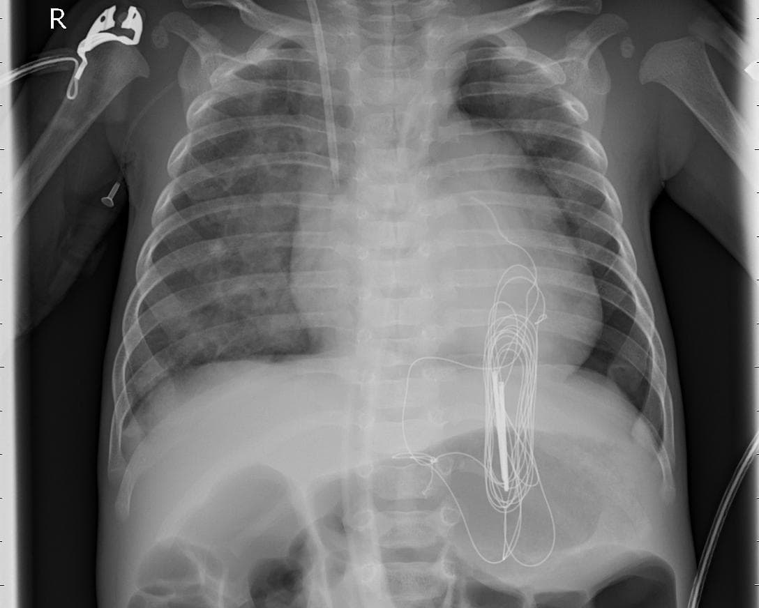 Pneumonia — NIH Chest X-ray14