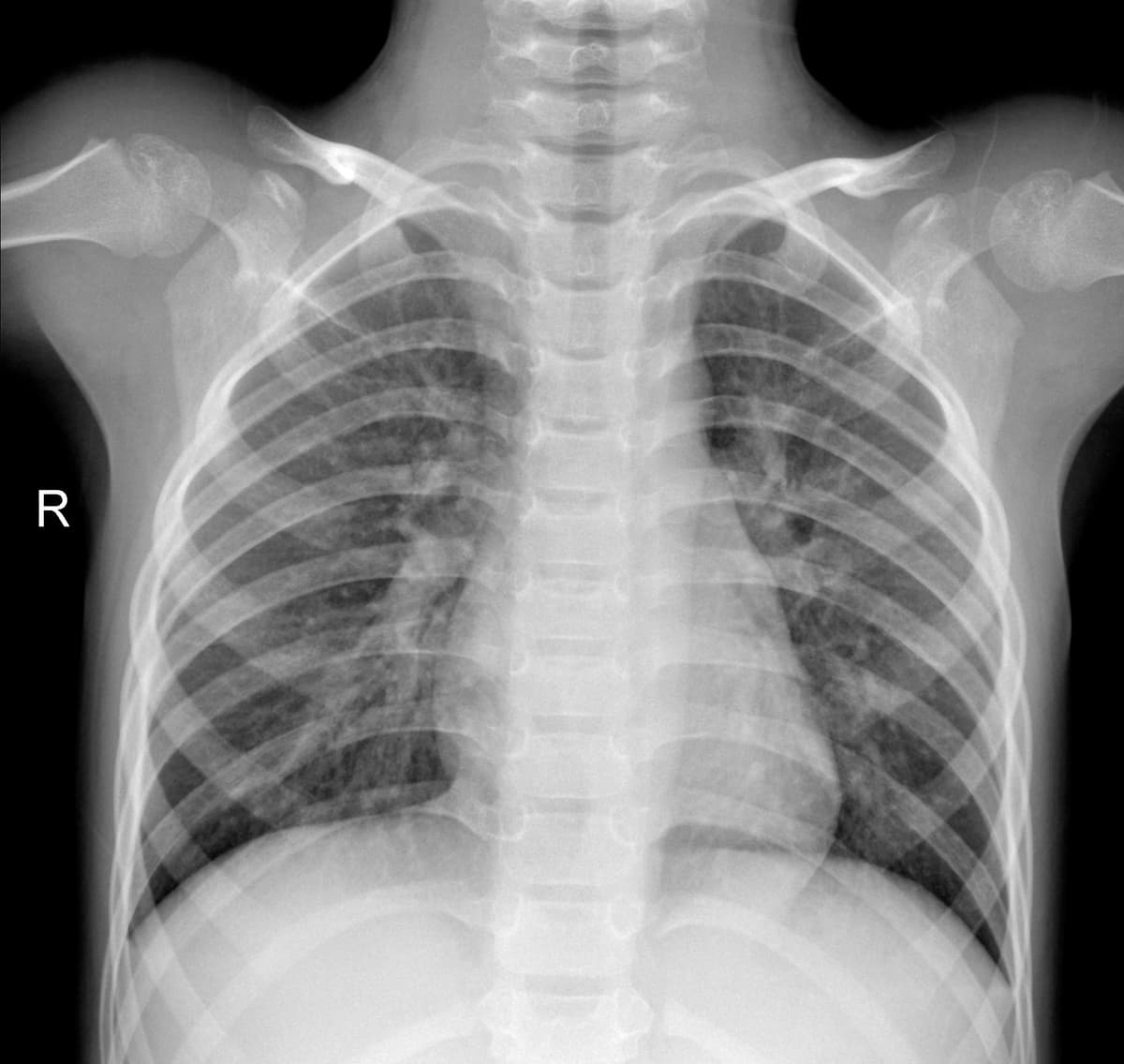 Radiografia Normal — NIH Chest X-ray14