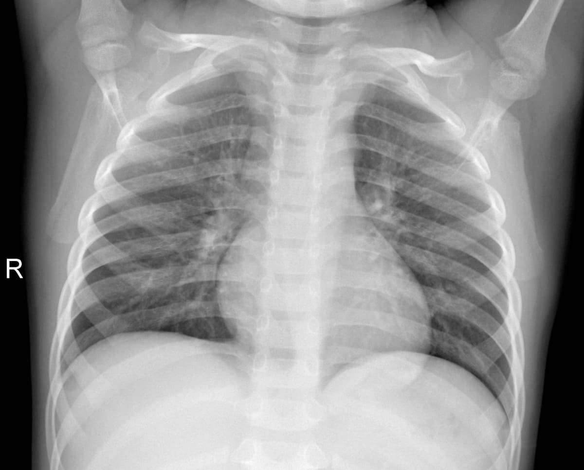 Radiografia Normal — NIH Chest X-ray14