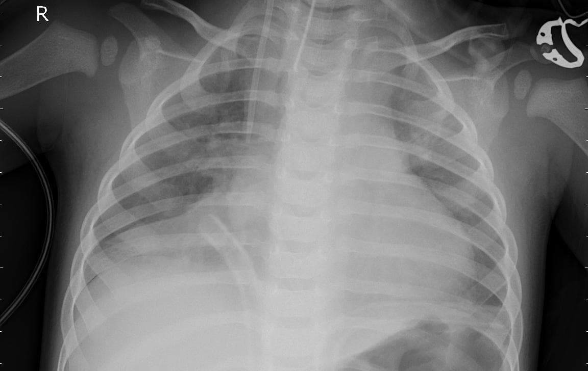 Pneumonia — NIH Chest X-ray14