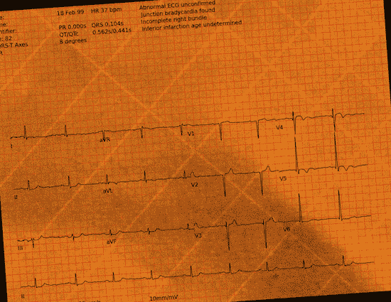 Normal ECG — PTB-XL