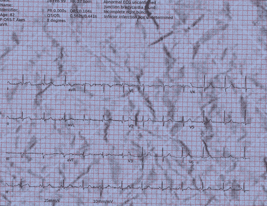 Normal ECG — PTB-XL