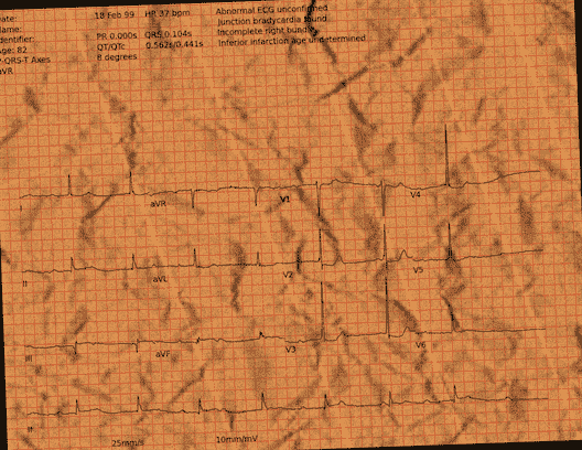 Normal ECG — PTB-XL