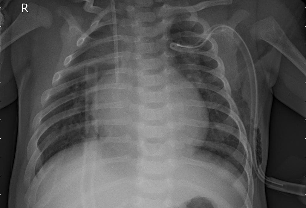 Pneumonia — NIH Chest X-ray14
