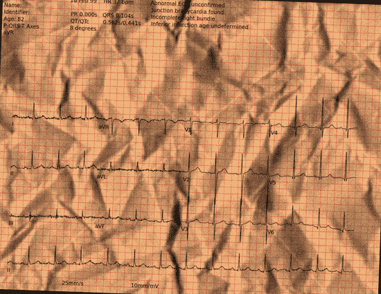 Normal ECG — PTB-XL