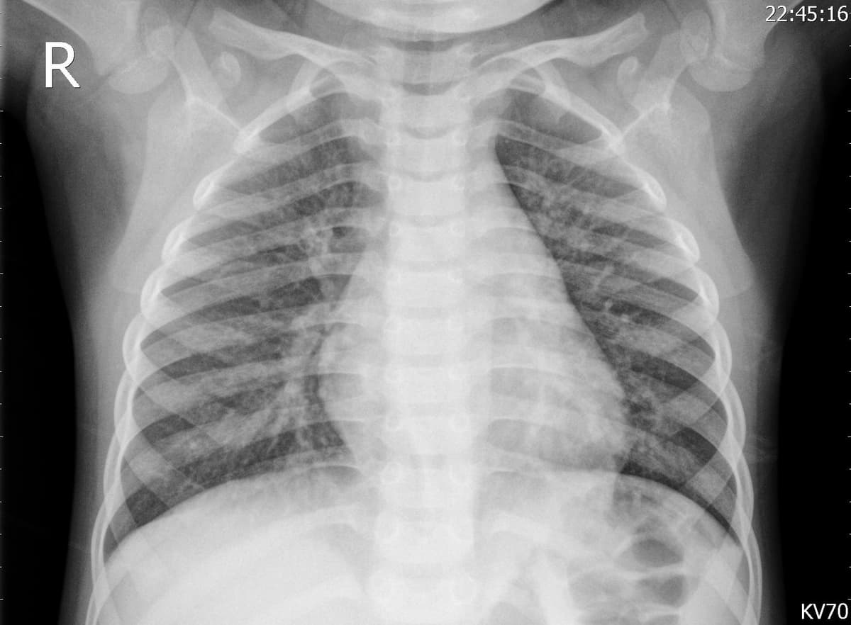 Pneumonia — NIH Chest X-ray14