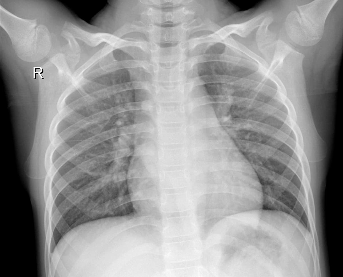 Radiografia Normal — NIH Chest X-ray14