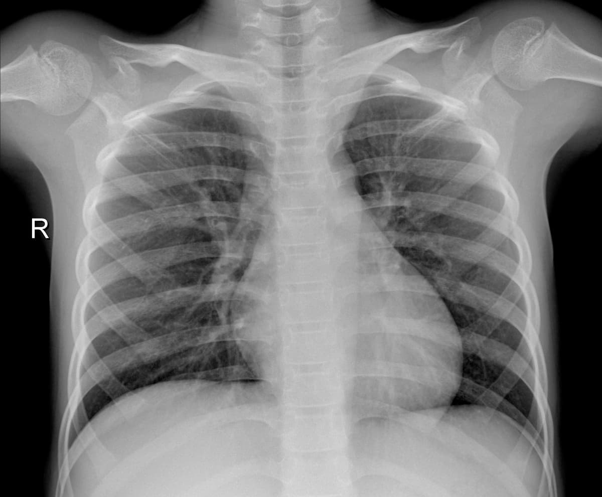 Radiografia Normal — NIH Chest X-ray14