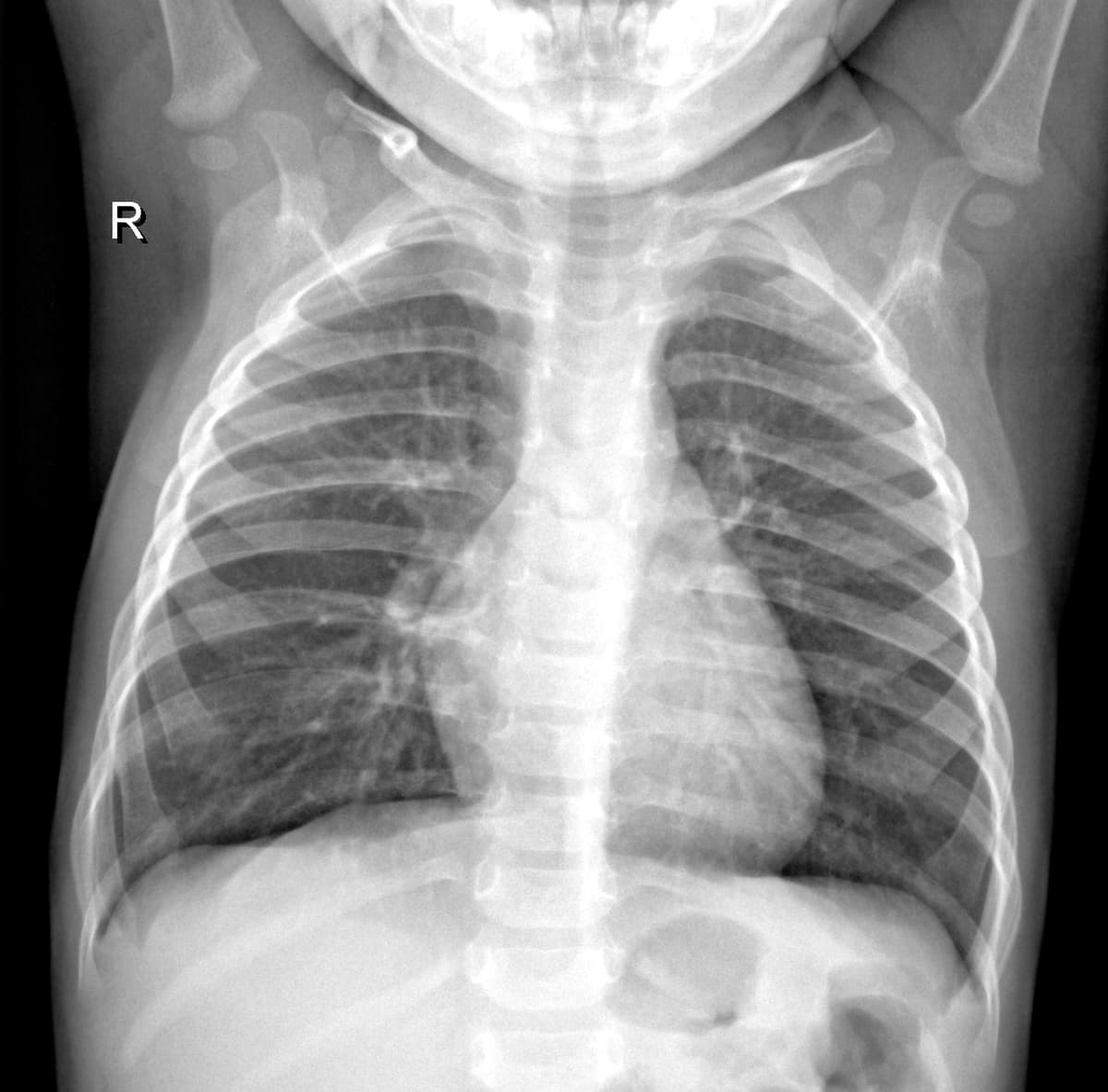 Radiografia Normal — NIH Chest X-ray14