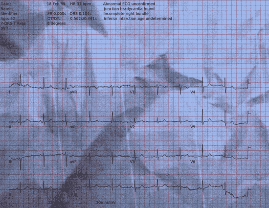 Normal ECG — PTB-XL