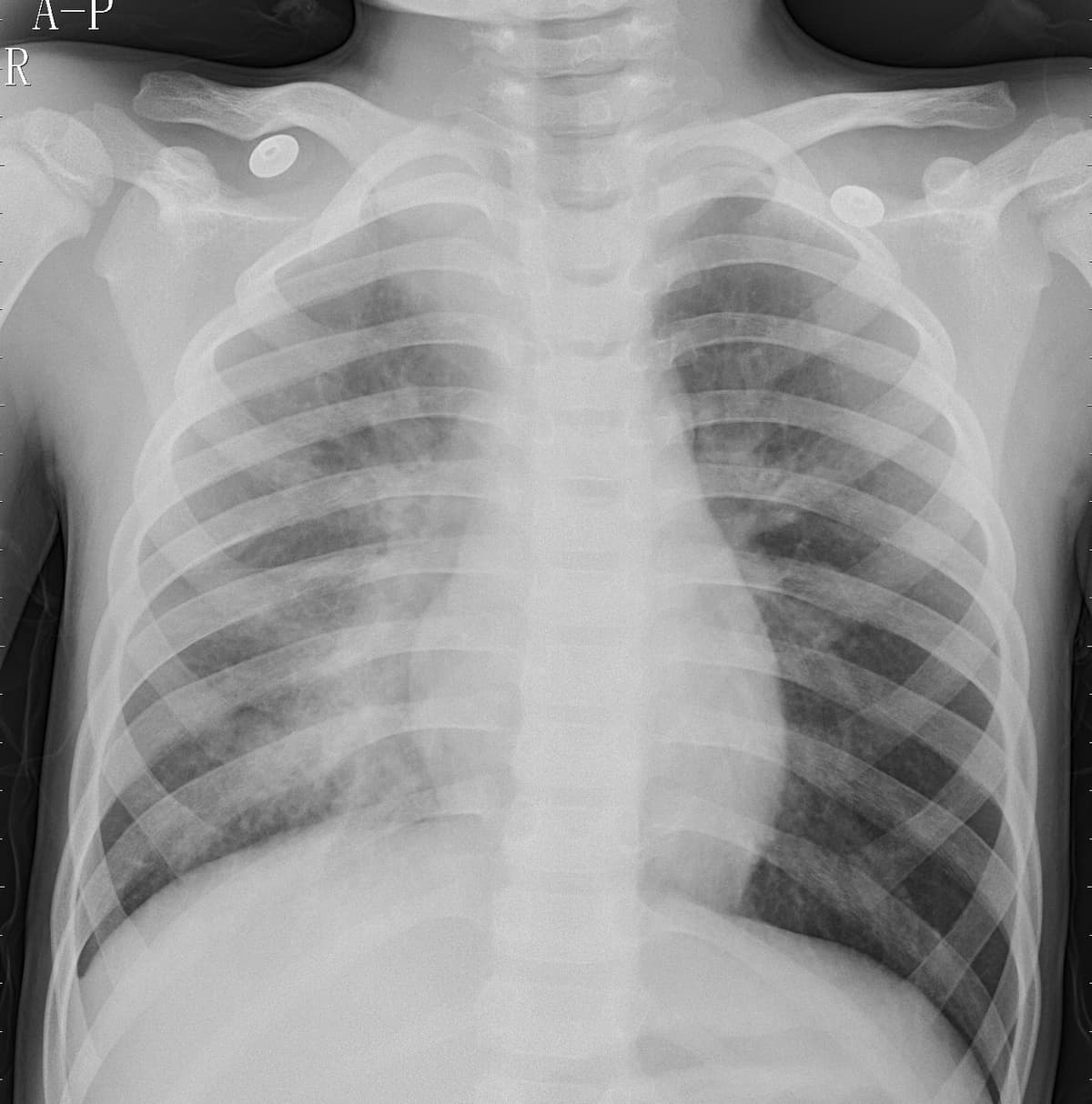 Pneumonia — NIH Chest X-ray14