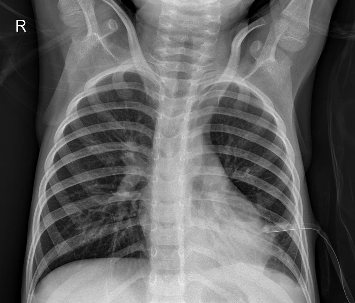 Pneumonia — NIH Chest X-ray14