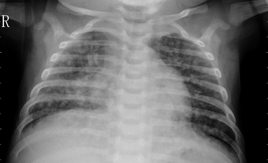 Pneumonia — NIH Chest X-ray14