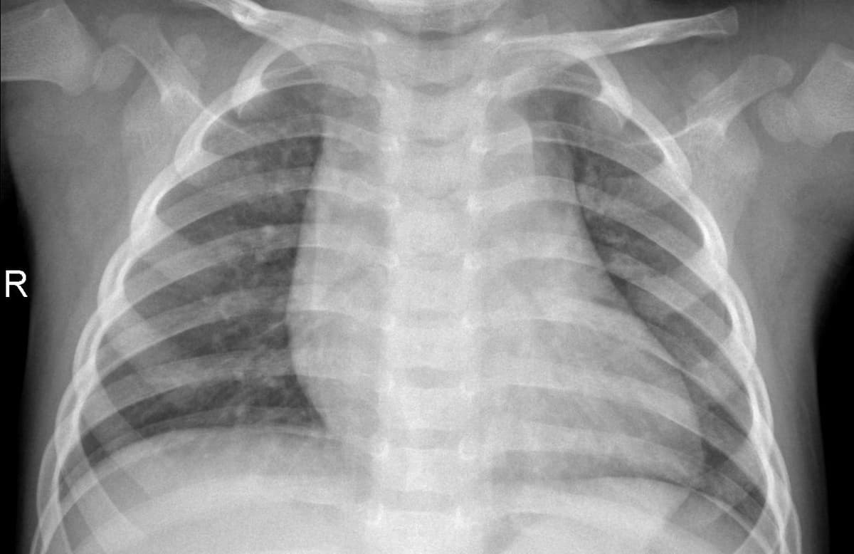 Pneumonia — NIH Chest X-ray14