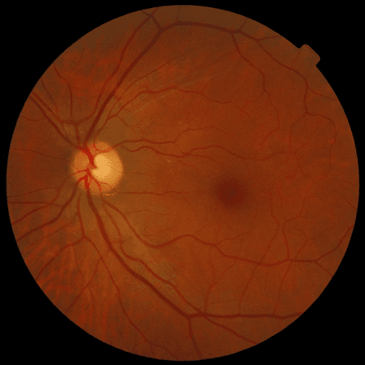 No Diabetic Retinopathy — MESSIDOR-2