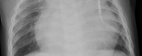 Pneumonia — NIH Chest X-ray14