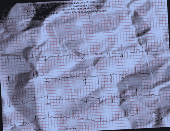 Normal ECG — PTB-XL