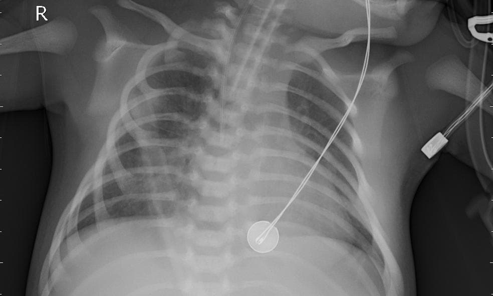 Pneumonia — NIH Chest X-ray14