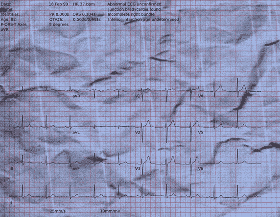 Normal ECG — PTB-XL