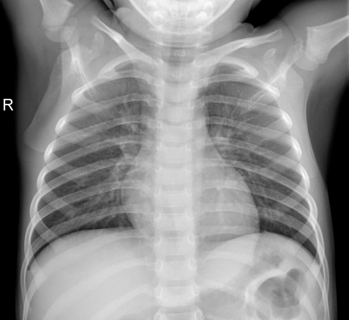 Radiografia Normal — NIH Chest X-ray14