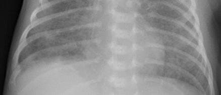 Pneumonia — NIH Chest X-ray14