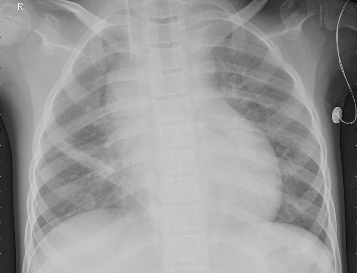 Pneumonia — NIH Chest X-ray14