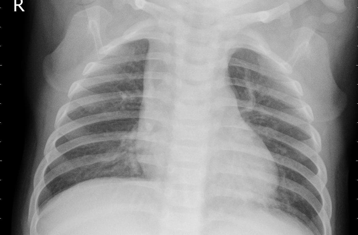 Pneumonia — NIH Chest X-ray14