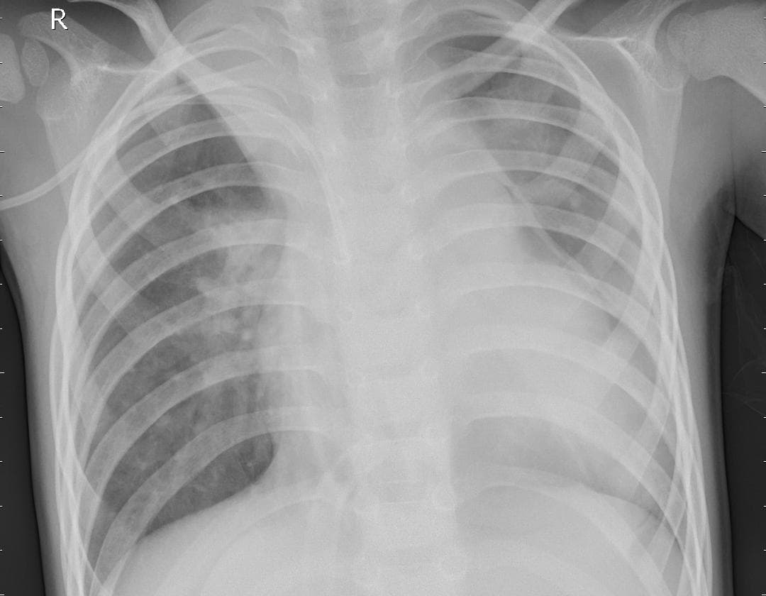 Pneumonia — NIH Chest X-ray14