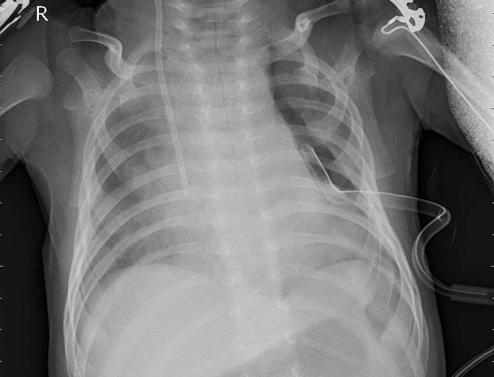 Pneumonia — NIH Chest X-ray14