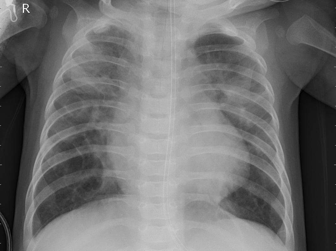Pneumonia — NIH Chest X-ray14