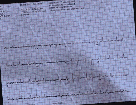 Normal ECG — PTB-XL