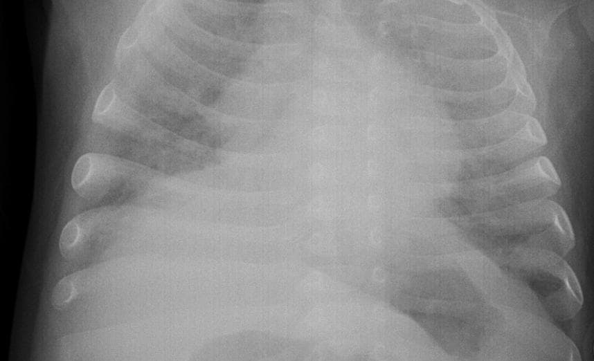 Pneumonia — NIH Chest X-ray14