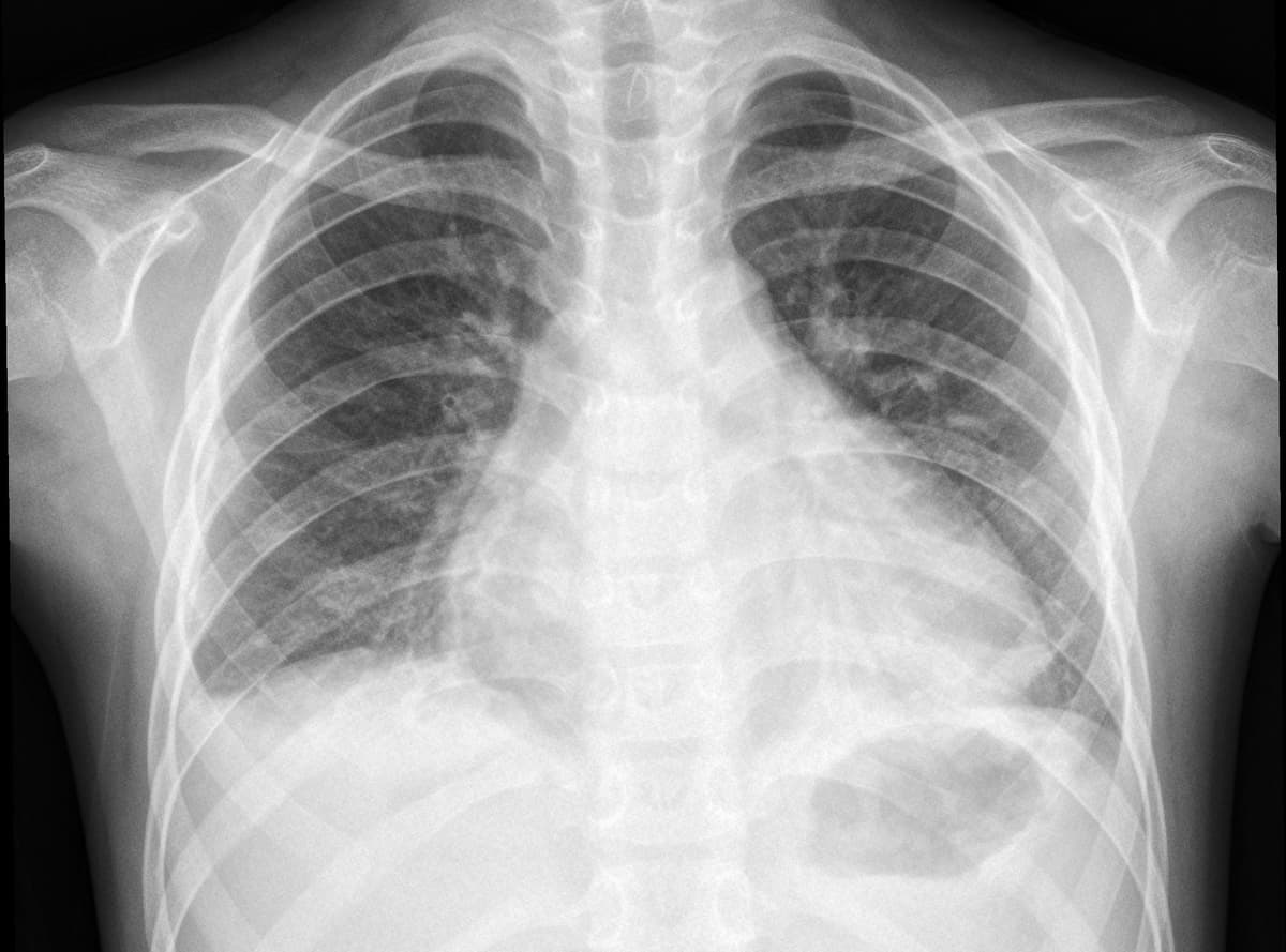 Pneumonia — NIH Chest X-ray14