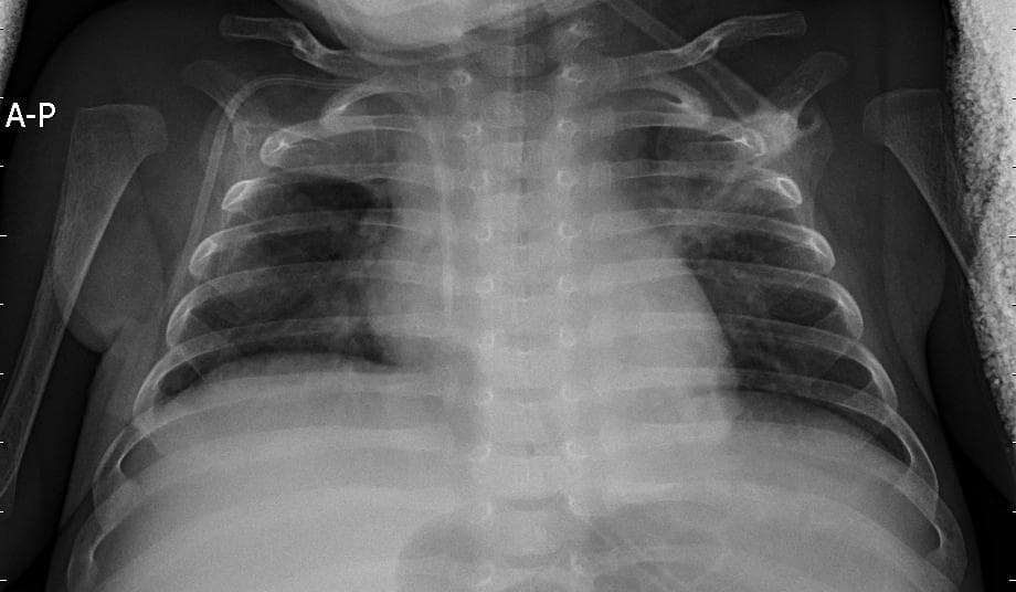 Pneumonia — NIH Chest X-ray14