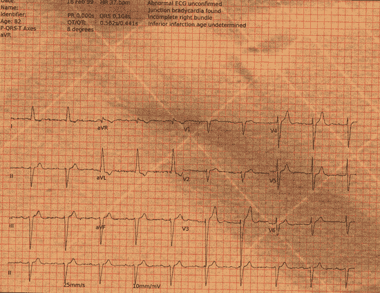 Normal ECG — PTB-XL