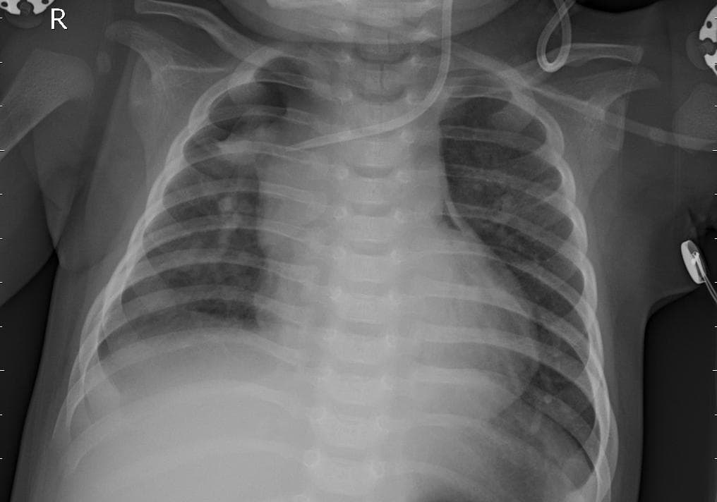 Pneumonia — NIH Chest X-ray14