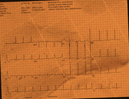 Normal ECG — PTB-XL