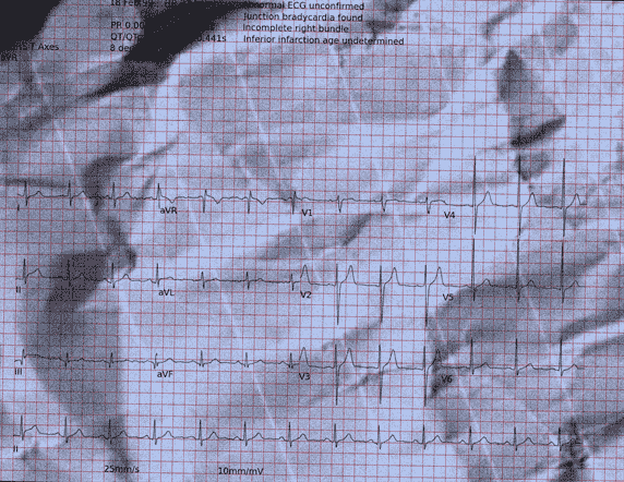 Normal ECG — PTB-XL