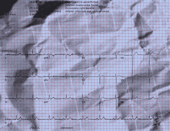 Normal ECG — PTB-XL