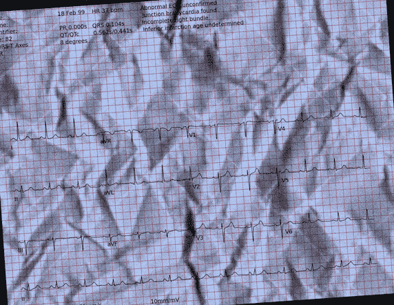 Normal ECG — PTB-XL