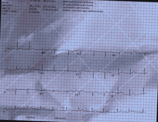 Normal ECG — PTB-XL
