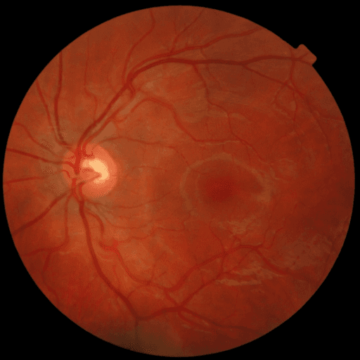 Proliferative DR — MESSIDOR-2