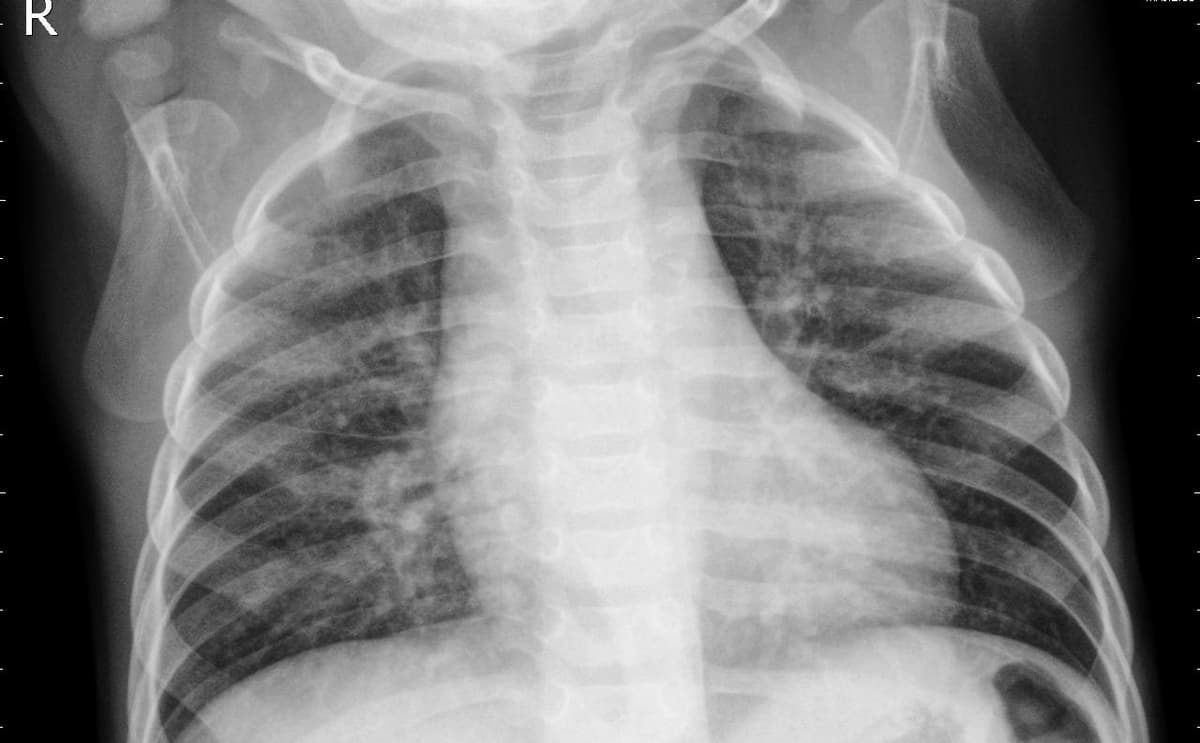 Pneumonia — NIH Chest X-ray14