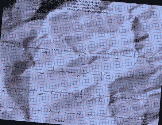 Normal ECG — PTB-XL